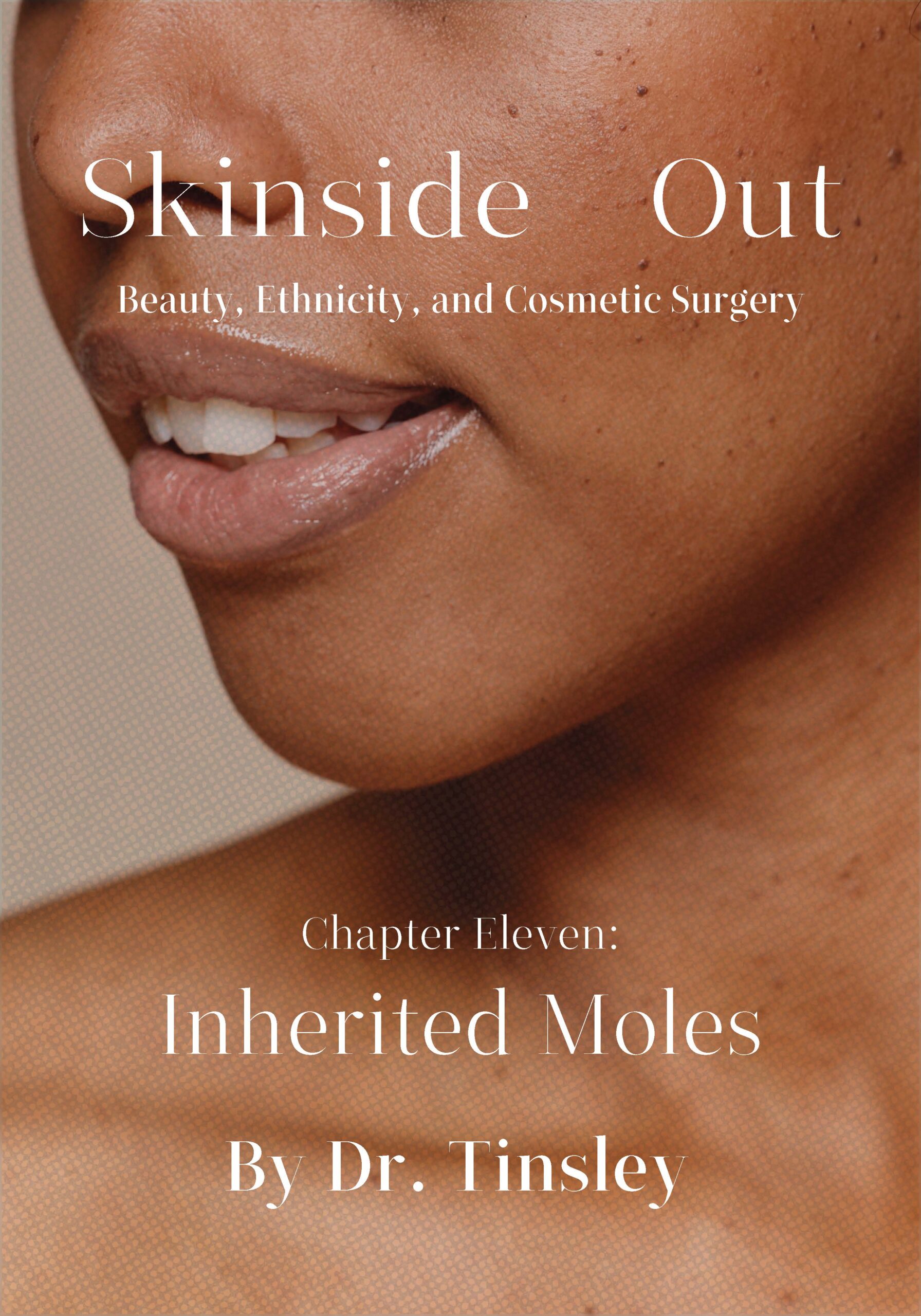 Skinside Out: Chapter 11 - Inherited Moles (eBook)